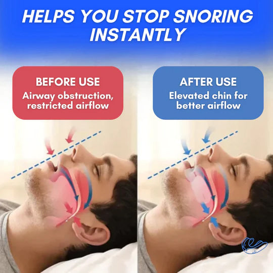 Anti-Snoring Mouthpiece